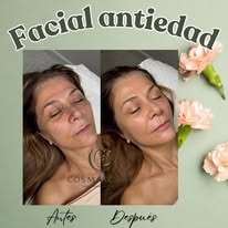 Facial antiedad antes y después